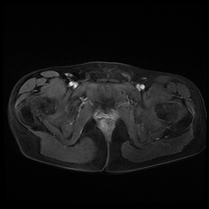 Ambiguous genitalia (Radiopaedia 69686-79643 Axial T1 C+ fat sat 42).jpg