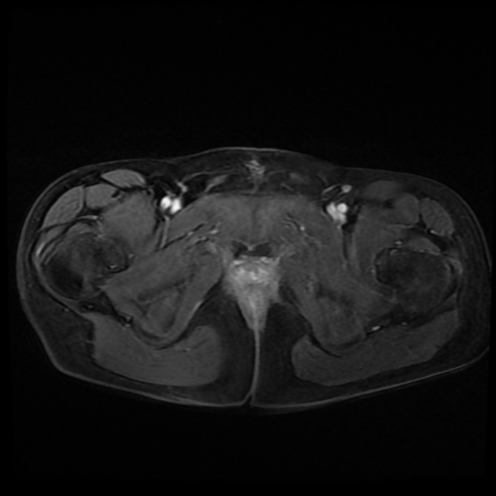 Ambiguous genitalia (Radiopaedia 69686-79643 Axial T1 C+ fat sat 45).jpg