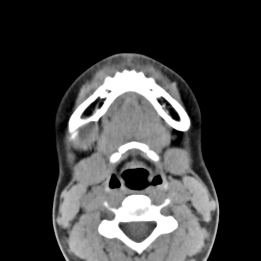 File:Ameloblastoma (Radiopaedia 26645-26793 Axial C+ delayed 10).jpg