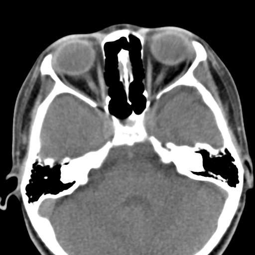 File:Ameloblastoma (Radiopaedia 26645-26793 Axial C+ delayed 41).jpg