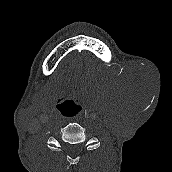 Ameloblastoma (Radiopaedia 51921-57766 Axial bone window 36).jpg