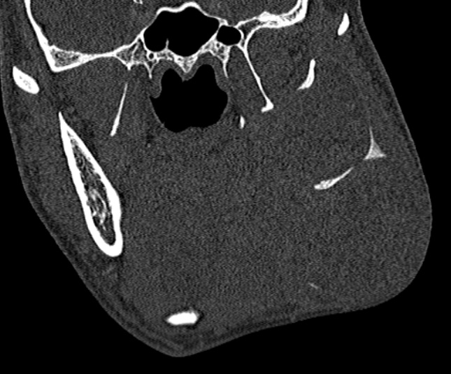 Ameloblastoma (Radiopaedia 51921-57766 Coronal bone window 135).jpg