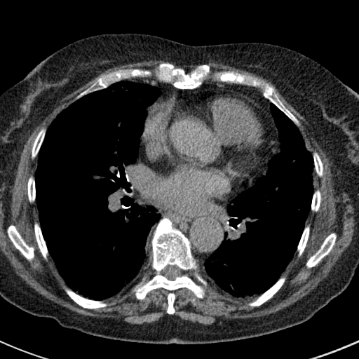 File:Amiodarone-induced pulmonary fibrosis (Radiopaedia 82355-96460 Axial non-contrast 35).jpg