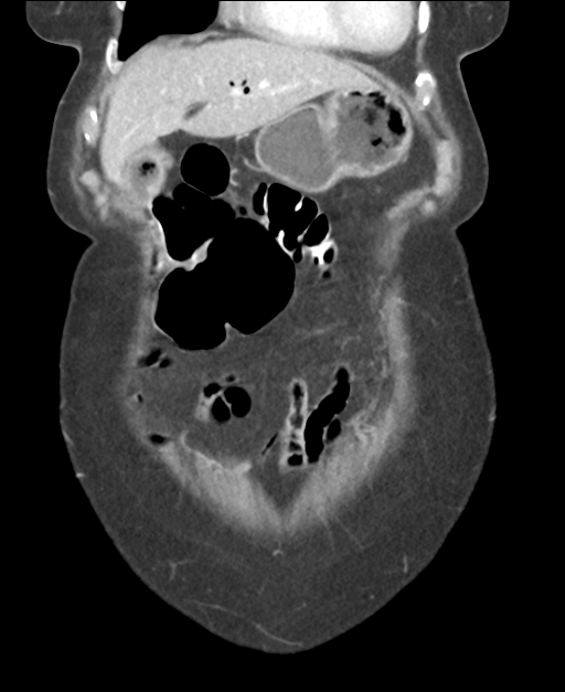 Ampullary adenocarcinoma (Radiopaedia 34013-35237 E 13).png