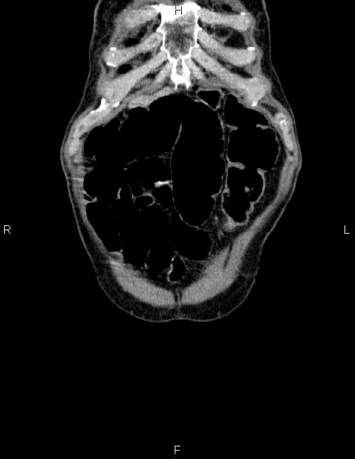 Ampullary adenocarcinoma (Radiopaedia 86093-102032 C 1).jpg