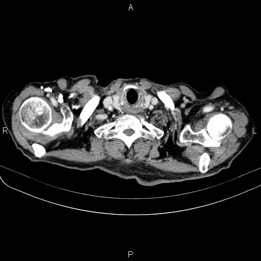 Ampullary adenocarcinoma (Radiopaedia 86093-102033 B 10).jpg