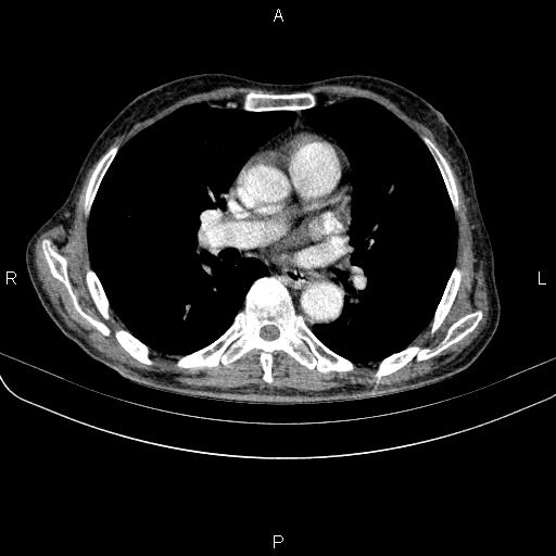 Ampullary adenocarcinoma (Radiopaedia 86093-102033 B 33).jpg