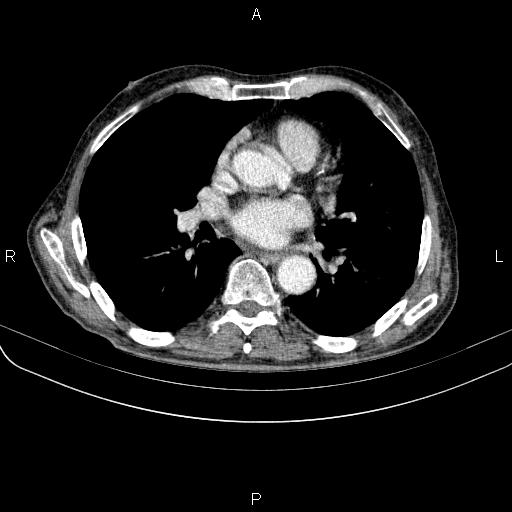 Ampullary adenocarcinoma (Radiopaedia 86093-102033 B 35).jpg