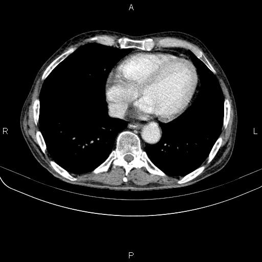 Ampullary adenocarcinoma (Radiopaedia 86093-102033 B 42).jpg