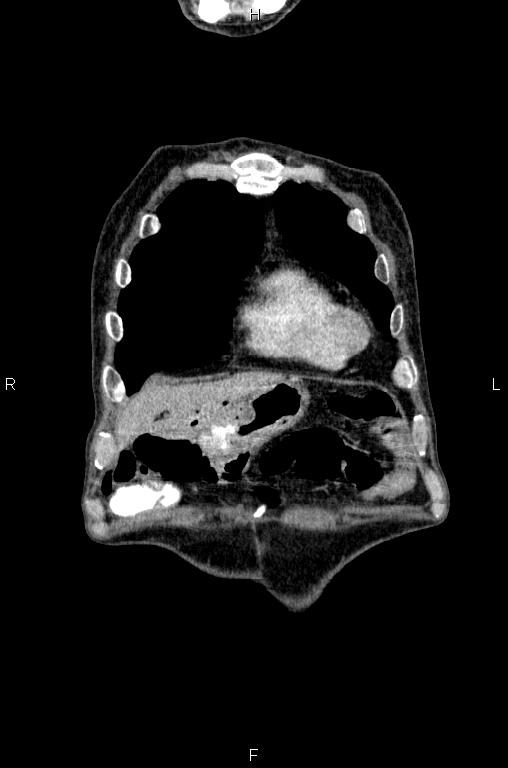 Ampullary adenocarcinoma (Radiopaedia 86093-102033 D 6).jpg