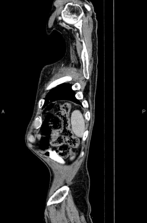 Ampullary adenocarcinoma (Radiopaedia 86093-102033 E 88).jpg