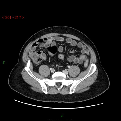 Ampullary carcinoma (Radiopaedia 56396-63056 C 72).jpg