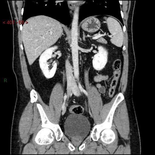 Ampullary carcinoma (Radiopaedia 56396-63056 E 57).jpg