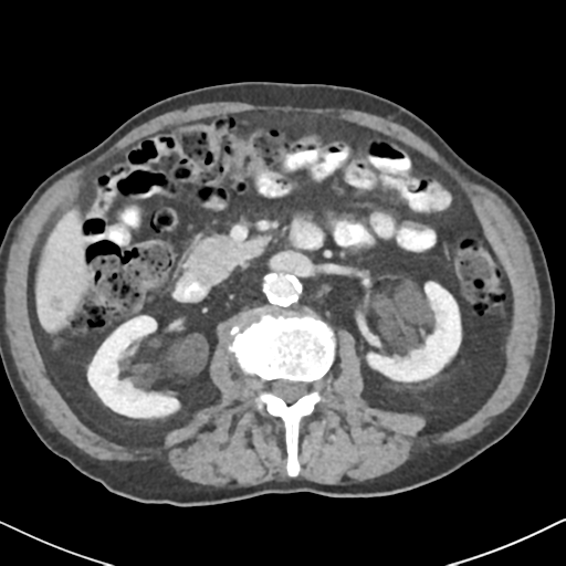 File:Amyand hernia (Radiopaedia 39300-41547 A 28).png