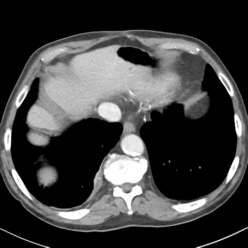 File:Amyand hernia (Radiopaedia 39300-41547 A 5).png