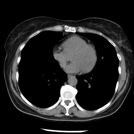 Amyloidosis - bronchial and diffuse nodular pulmonary involvement (Radiopaedia 60156-67744 Axial non-contrast 37).jpg
