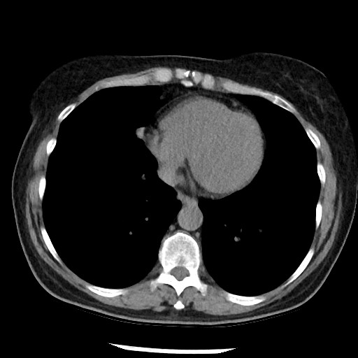 File:Amyloidosis - bronchial and diffuse nodular pulmonary involvement (Radiopaedia 60156-67744 Axial non-contrast 40).jpg