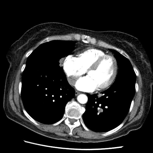 Amyloidosis - bronchial and diffuse nodular pulmonary involvement (Radiopaedia 60156-67745 A 36).jpg
