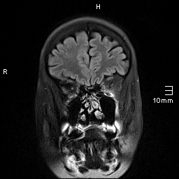 File:Amyotrophic lateral sclerosis (Radiopaedia 70821-81017 Coronal FLAIR 7).jpg