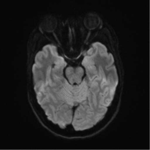 Anaplastic astrocytoma IDH mutant (Radiopaedia 50046-55341 Axial DWI 37).png