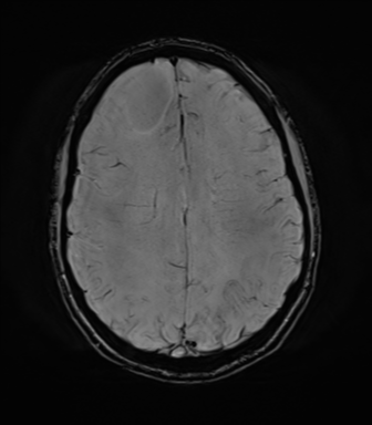 File:Anaplastic astrocytoma IDH mutant (Radiopaedia 50046-55341 Axial SWI 60).png
