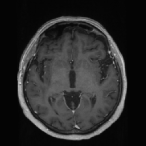 File:Anaplastic astrocytoma IDH wild-type (pseudoprogression) (Radiopaedia 42209-45278 Axial T1 C+ 77).png