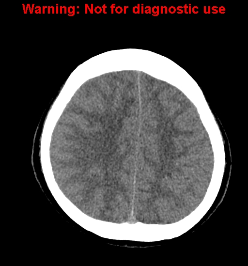 File:Anaplastic ganglioglioma (Radiopaedia 44921-48815 Axial non-contrast 21).jpg