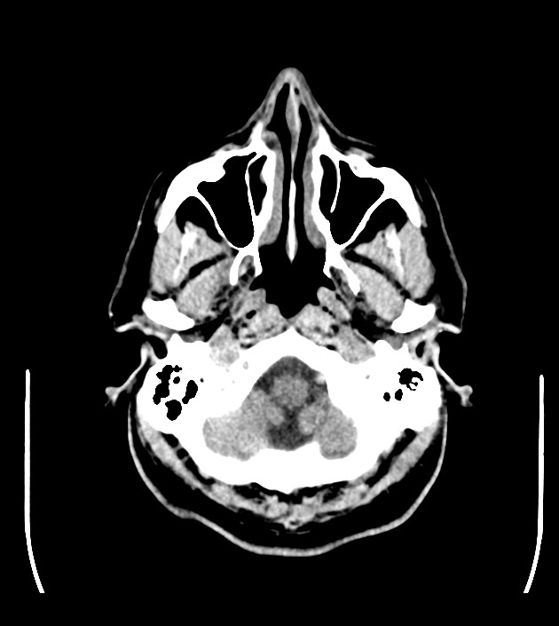 Anaplastic oligodendroglioma (Radiopaedia 79571-92753 Axial non-contrast 10).jpg