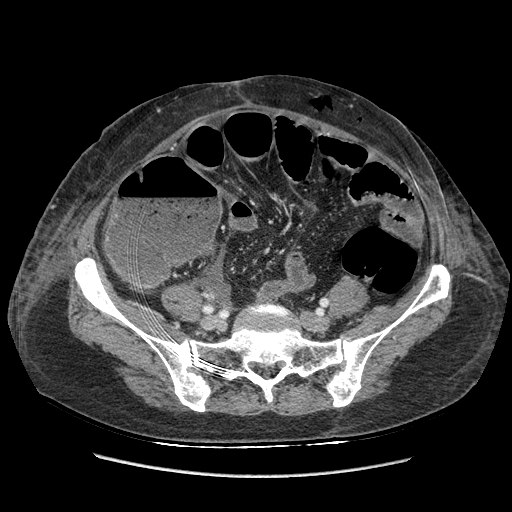 Anastomosis leak at ileostomy closure site (Radiopaedia 82138-96184 B 164).jpg