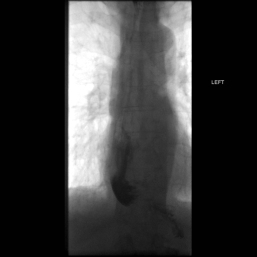 File:Anastomotic stricture post Ivor Lewis esophagectomy (Radiopaedia 47937-52715 B 55).png