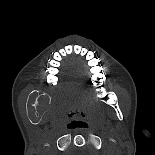 Aneurysmal bone cyst of the mandible (Radiopaedia 43280-46601 Axial bone window 37).jpg