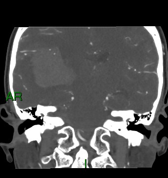 Aneurysmal subarachnoid hemorrhage with intra-axial extension (Radiopaedia 84371-99732 C 46).jpg