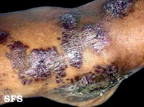 Angiokeratoma Circumscriptum (Dermatology Atlas 9).jpg