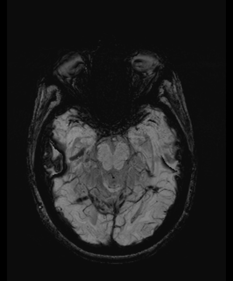 Angiomatous meningioma (Radiopaedia 79459-92579 E 22).jpg