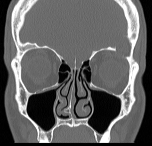 Angular epidermoid cyst (Radiopaedia 46908-51439 Coronal bone window 27).png