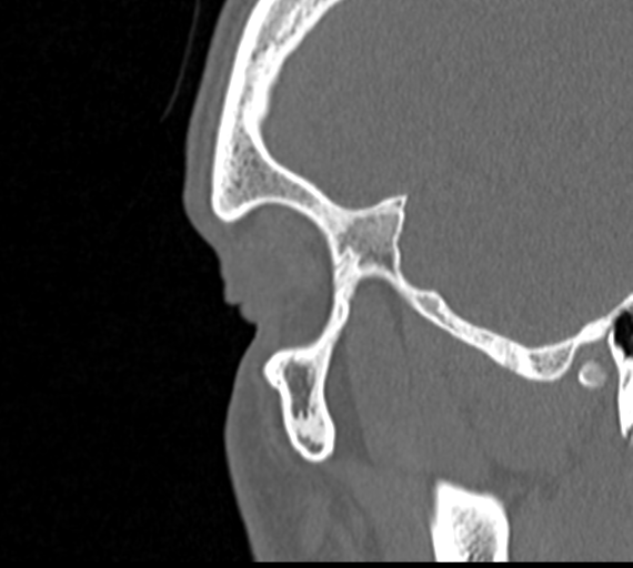 Angular epidermoid cyst (Radiopaedia 46908-51439 Sagittal bone window 2).png