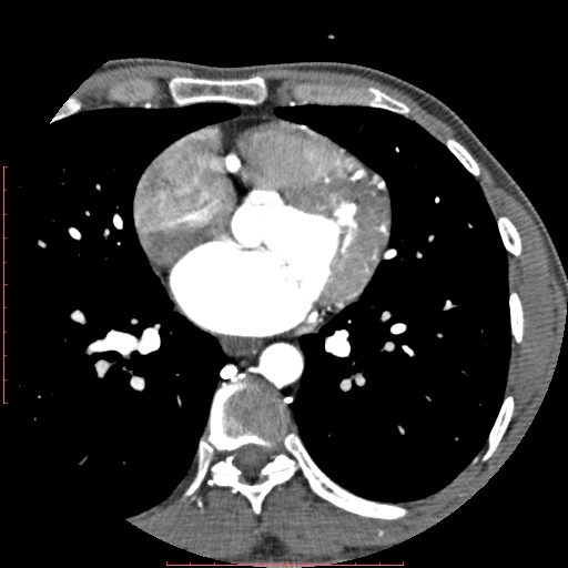 File:Anomalous left coronary artery from the pulmonary artery (ALCAPA) (Radiopaedia 70148-80181 A 171).jpg