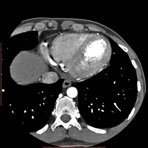 File:Anomalous left coronary artery from the pulmonary artery (ALCAPA) (Radiopaedia 70148-80181 A 314).jpg