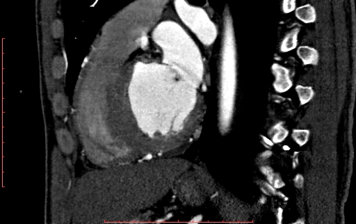 Anomalous left coronary artery from the pulmonary artery (ALCAPA) (Radiopaedia 70148-80181 C 150).jpg