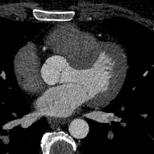 File:Anomalous origin of the left coronary artery with malignant course (Radiopaedia 77842-90126 C 115).jpeg