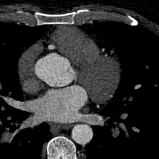 File:Anomalous origin of the left coronary artery with malignant course (Radiopaedia 77842-90126 C 76).jpeg