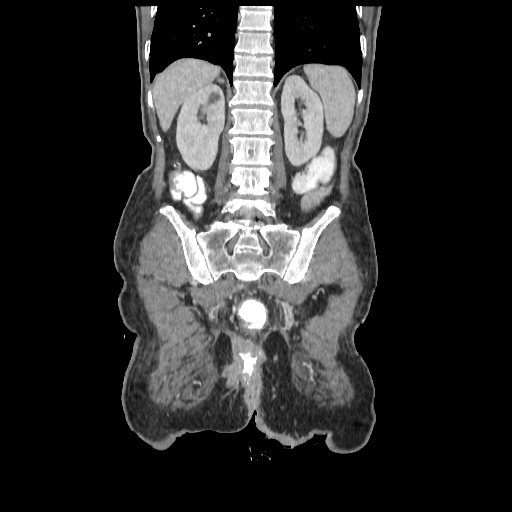 Anorectal carcinoma (Radiopaedia 44413-48064 B 65).jpg