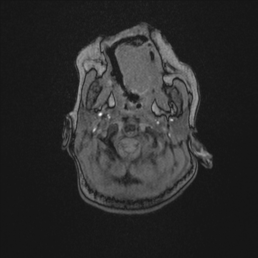 Anoxic brain injury (Radiopaedia 79165-92139 Axial MRA 9).jpg