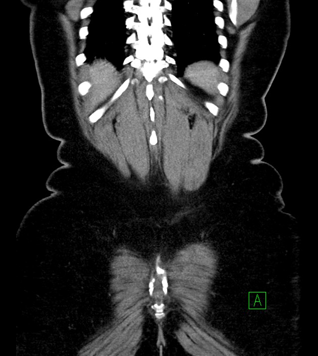 Anterior abdominal wall CSF pseudocyst (CSFoma) (Radiopaedia 79453-92571 B 49).jpg
