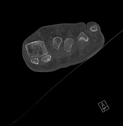 Anterior calcaneal process fracture (Radiopaedia 63353-71943 Axial bone window 44).jpg