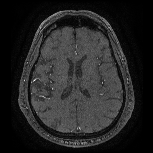 Anterior cerebral artery infarction (Radiopaedia 46794-51323 Axial MRA 131).jpg