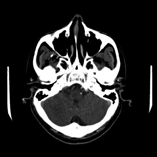 File:Anterior communicating artery aneurysm (Radiopaedia 16633-16335 A 7).jpg
