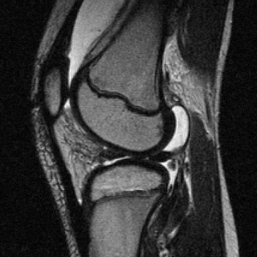 File:Anterior cruciate ligament avulsion fracture (Radiopaedia 24710-24974 Sagittal T2 13).jpg