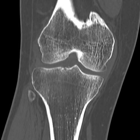 File:Anterior cruciate ligament avulsion fracture (Radiopaedia 58939-66194 Coronal bone window 16).jpg