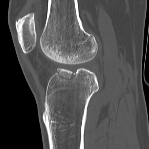 File:Anterior cruciate ligament avulsion fracture (Radiopaedia 58939-66194 Sagittal bone window 17).jpg
